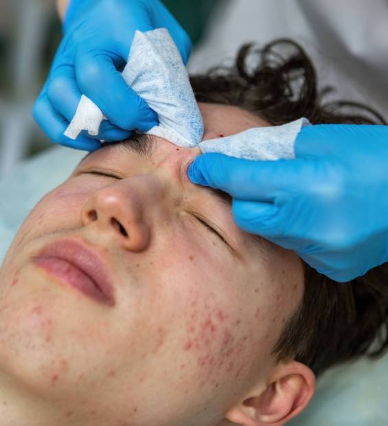 cosmetologist-treats-acne-teenage-boy-whose-face-is-covered-with-pimples-red-spots